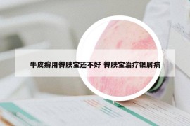 牛皮癬用得膚寶還不好 得膚寶治療銀屑病
