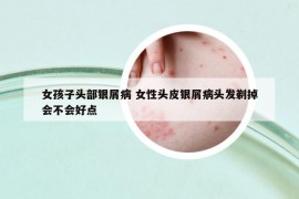 女孩子頭部銀屑病 女性頭皮銀屑病頭發(fā)剃掉會(huì)不會(huì)好點(diǎn)