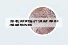 以前得過銀屑病現(xiàn)在的了玫瑰糠疹 銀屑病與玫瑰糠疹鑒別與治療