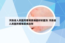 河南省人民醫(yī)院看銀屑病最好的醫(yī)生 河南省人民醫(yī)院看銀屑病怎樣
