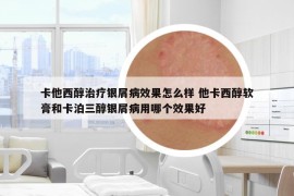 卡他西醇治療銀屑病效果怎么樣 他卡西醇軟膏和卡泊三醇銀屑病用哪個(gè)效果好