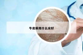 牛皮癬用什么水好