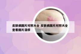 皮膚病圖片對照大全 皮膚病圖片對照大全 查看圖片濕疹