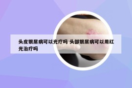 頭皮銀屑病可以光療嗎 頭部銀屑病可以用紅光治療嗎