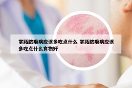 掌跖膿皰病應(yīng)該多吃點什么 掌跖膿皰病應(yīng)該多吃點什么食物好