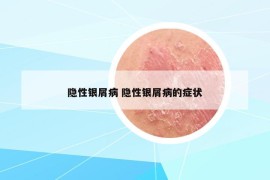 隱性銀屑病 隱性銀屑病的癥狀