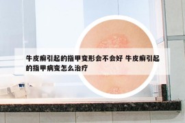 牛皮癬引起的指甲變形會(huì)不會(huì)好 牛皮癬引起的指甲病變怎么治療
