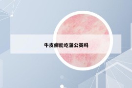 牛皮癬能吃蒲公英嗎