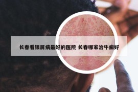 長(zhǎng)春看銀屑病最好的醫(yī)院 長(zhǎng)春哪家治牛癬好