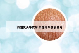 白醋洗頭牛皮癬 白醋治牛皮屑偏方