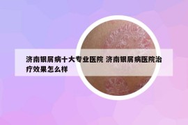 濟(jì)南銀屑病十大專業(yè)醫(yī)院 濟(jì)南銀屑病醫(yī)院治療效果怎么樣