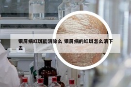 銀屑病紅斑能消除么 銀屑病的紅斑怎么消下去