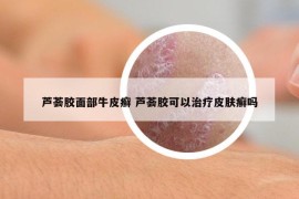 蘆薈膠面部牛皮癬 蘆薈膠可以治療皮膚癬嗎