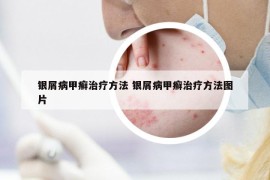 銀屑病甲癬治療方法 銀屑病甲癬治療方法圖片