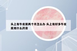 頭上有牛皮屑兩個月怎么辦 頭上有好多牛皮屑用什么藥膏