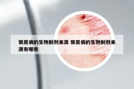 銀屑病的生物制劑來源 銀屑病的生物制劑來源有哪些