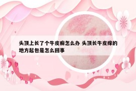 頭頂上長了個(gè)牛皮癬怎么辦 頭頂長牛皮癢的地方起包是怎么回事