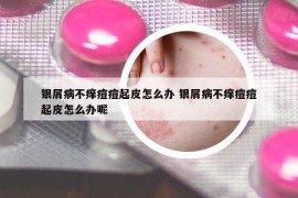 銀屑病不癢痘痘起皮怎么辦 銀屑病不癢痘痘起皮怎么辦呢