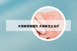 大錢癬初期圖片 大錢蘚怎么治療