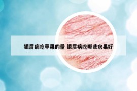 銀屑病吃蘋果的量 銀屑病吃哪些水果好