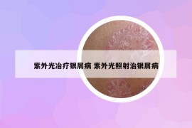 紫外光冶療銀屑病 紫外光照射治銀屑病