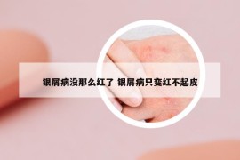 銀屑病沒(méi)那么紅了 銀屑病只變紅不起皮