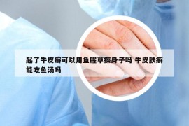 起了牛皮癬可以用魚腥草擦身子嗎 牛皮膚癬能吃魚湯嗎