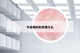 牛皮癬的形狀像什么