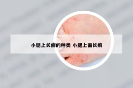 小腿上長癬的種類 小腿上面長癬