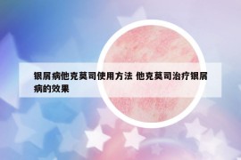 銀屑病他克莫司使用方法 他克莫司治療銀屑病的效果