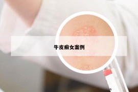 牛皮癬女案例