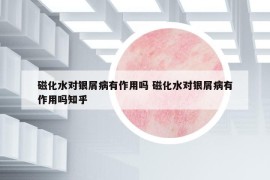 磁化水對(duì)銀屑病有作用嗎 磁化水對(duì)銀屑病有作用嗎知乎