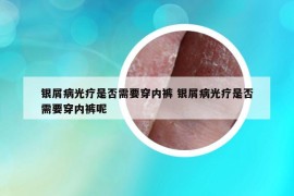 銀屑病光療是否需要穿內(nèi)褲 銀屑病光療是否需要穿內(nèi)褲呢