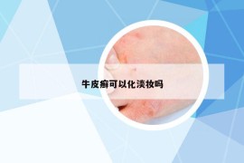 牛皮癬可以化淡妝嗎