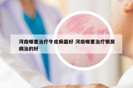河南哪里治療牛皮癬最好 河南哪里治療銀屑病治的好