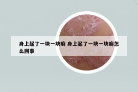 身上起了一塊一塊癬 身上起了一塊一塊癬怎么回事