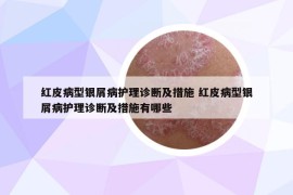 紅皮病型銀屑病護(hù)理診斷及措施 紅皮病型銀屑病護(hù)理診斷及措施有哪些
