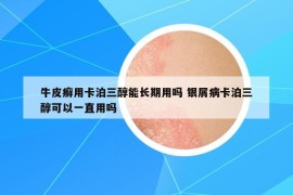 牛皮癬用卡泊三醇能長期用嗎 銀屑病卡泊三醇可以一直用嗎
