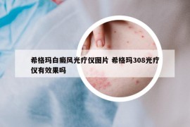 希格瑪白癜風光療儀圖片 希格瑪308光療儀有效果嗎