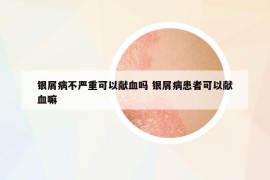 銀屑病不嚴重可以獻血嗎 銀屑病患者可以獻血嘛