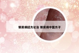 銀屑病經(jīng)方論治 銀屑病中醫(yī)方子