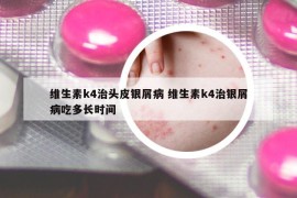 維生素k4治頭皮銀屑病 維生素k4治銀屑病吃多長(zhǎng)時(shí)間