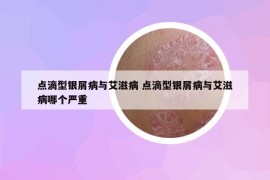 點(diǎn)滴型銀屑病與艾滋病 點(diǎn)滴型銀屑病與艾滋病哪個(gè)嚴(yán)重