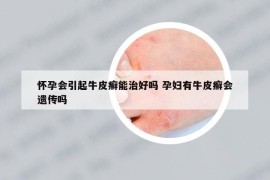 懷孕會(huì)引起牛皮癬能治好嗎 孕婦有牛皮癬會(huì)遺傳嗎