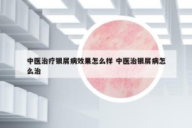 中醫(yī)治療銀屑病效果怎么樣 中醫(yī)治銀屑病怎么治