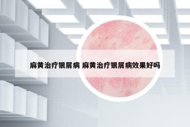 麻黃治療銀屑病 麻黃治療銀屑病效果好嗎