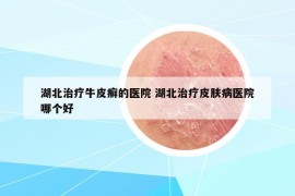 湖北治療牛皮癬的醫(yī)院 湖北治療皮膚病醫(yī)院哪個(gè)好