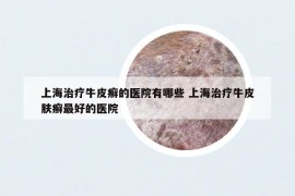上海治療牛皮癬的醫(yī)院有哪些 上海治療牛皮膚癬最好的醫(yī)院