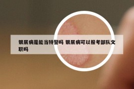 銀屑病是能當(dāng)特警嗎 銀屑病可以報(bào)考部隊(duì)文職嗎
