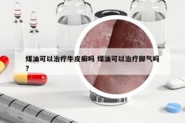 煤油可以治療牛皮癬嗎 煤油可以治療腳氣嗎?